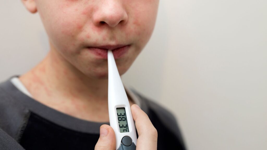 Brote De Sarampión Enciende Alarmas De Salud Pública Cerca De Las Vegas