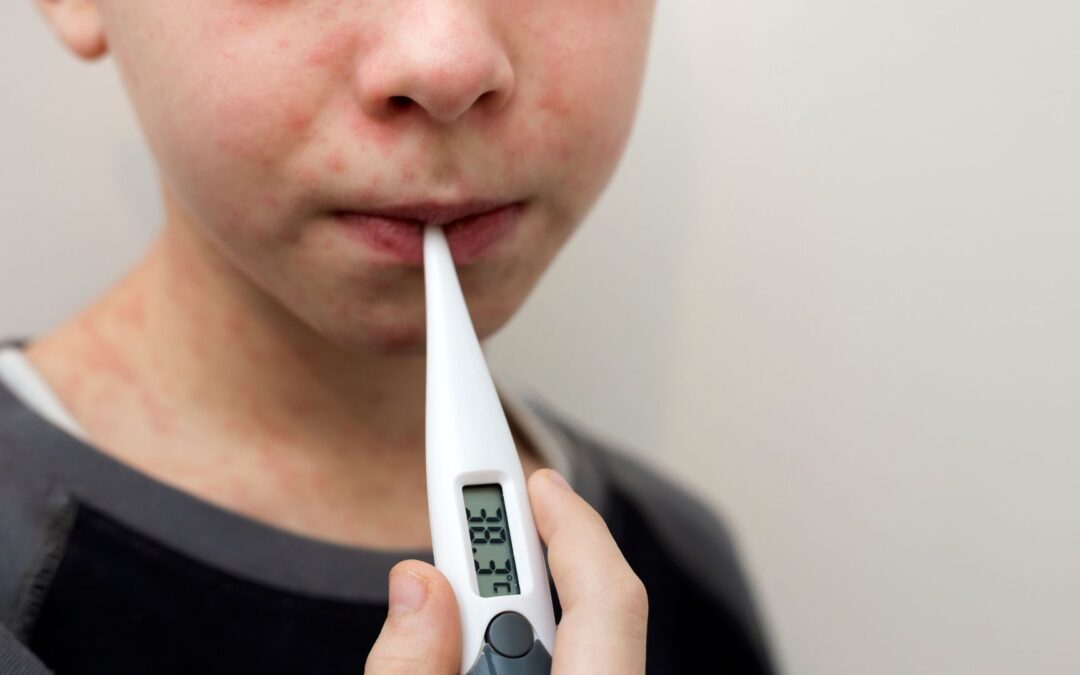 Brote de Sarampión Enciende Alarmas de Salud Pública Cerca de Las Vegas