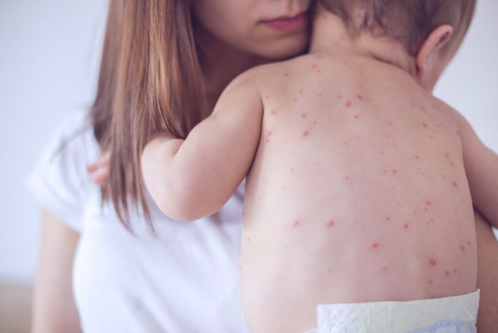 Primer Caso De Sarampión Confirmado En Un Bebé Del Condado Clark: ¿Qué Debes Saber? - Noticias Notivalle Primer Caso De Sarampión Confirmado En Un Bebé Del Condado Clark: ¿Qué Debes Saber?