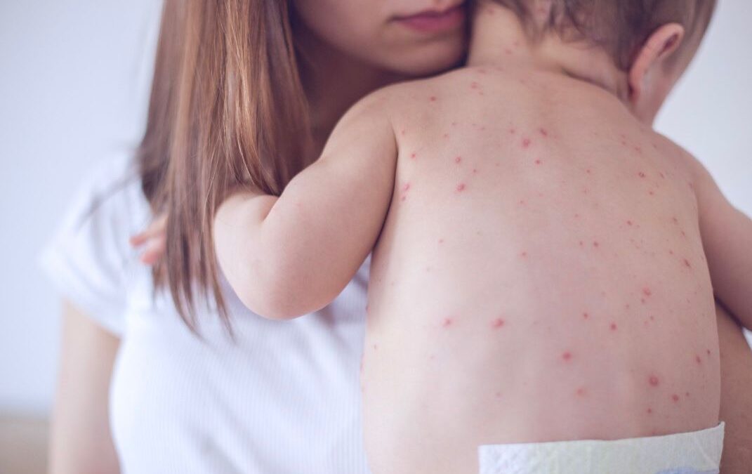 Primer Caso de Sarampión en Bebé del Condado Clark: Lo Que Debes Saber