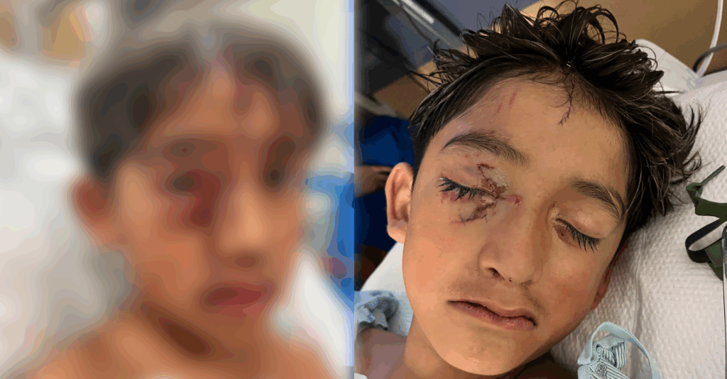 Ataque De Perros: Niño De 9 Años Herido Por Pitbulls En Sunland Park Pide Ayuda A La Comunidad