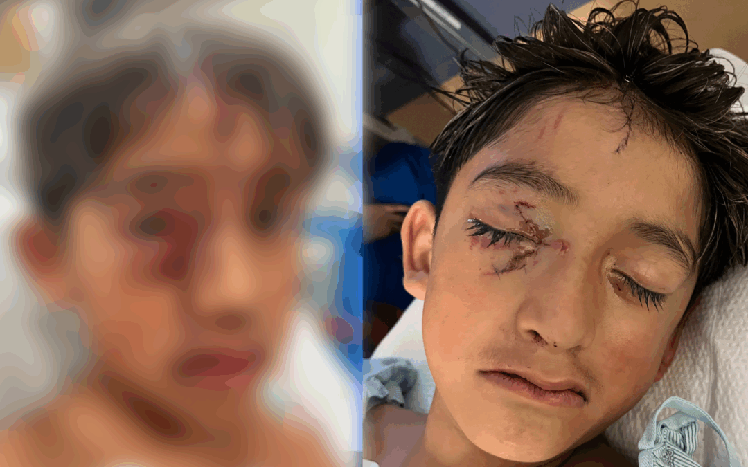 Ataque de Perros: Niño de 9 Años Herido por Pitbulls en Sunland Park Pide Ayuda a la Comunidad