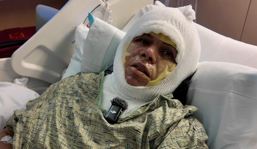 Trágica Explosión En Imperial Beach: Diana Hernández, Madre Soltera, Lucha Por Su Recuperación