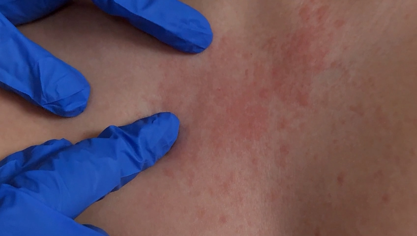 Alerta de Salud: Brote de Sarampión en Mexicali Afecta a la Comunidad