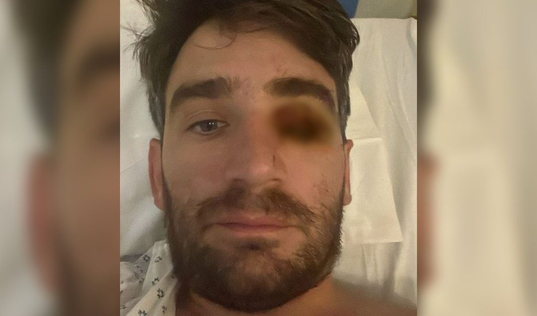 Año Nuevo Trágico: Hombre Pierde un Ojo por Explosión de Fuego Pirotécnico