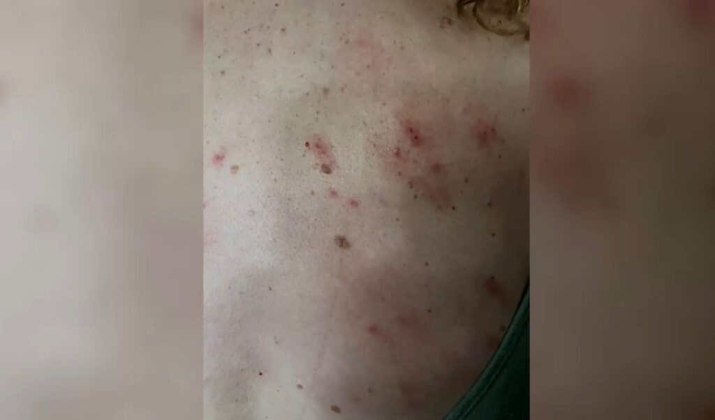 Crisis De Chinches En El Paso: Madre Lucero Castro Alza La Voz Por Riesgo Sanitario - Noticias Notivalle Crisis De Chinches En El Paso: Madre Lucero Castro Alza La Voz Por Riesgo Sanitario