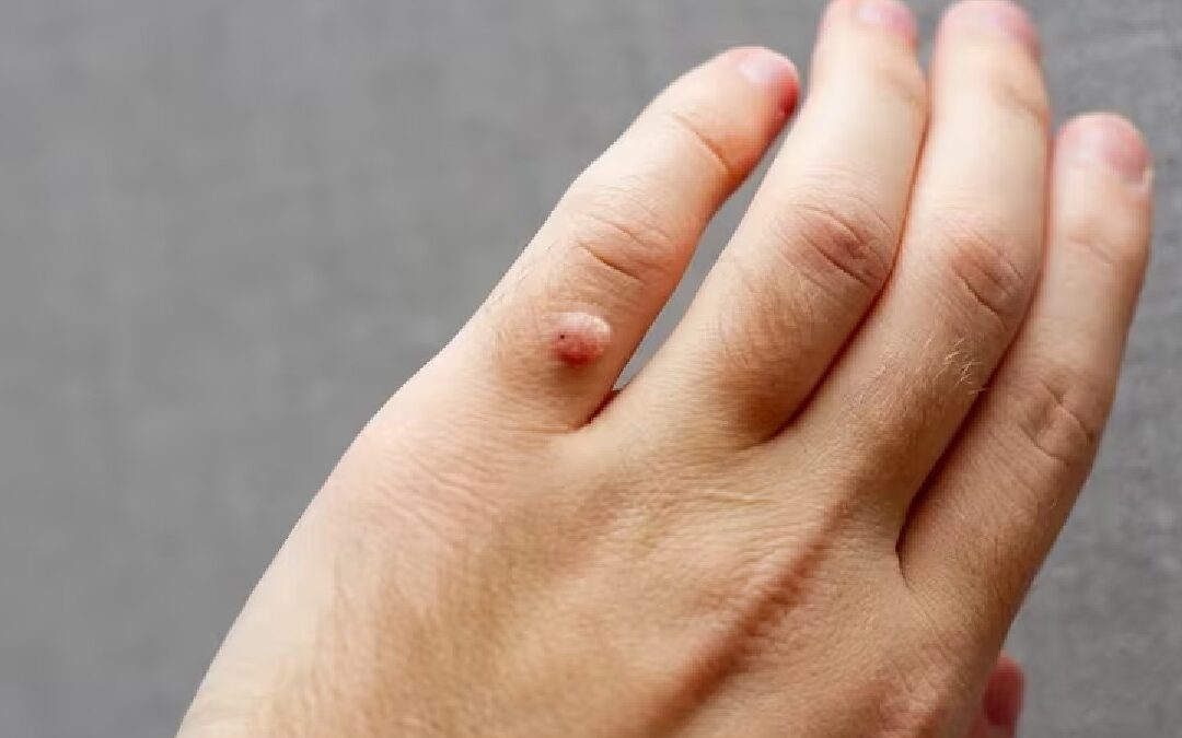 El VPH no siempre conduce al cáncer, aclara especialista