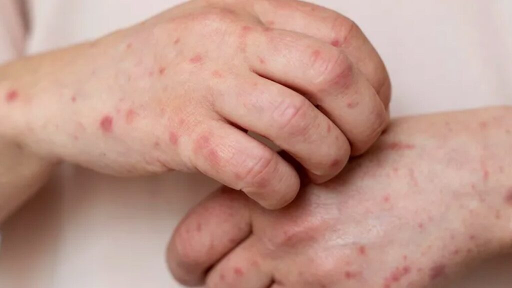 Alertan Sobre Brotes De Sarampión En Torreón: 4 Casos Confirmados - Noticias Notivalle Alertan Sobre Brotes De Sarampión En Torreón: 4 Casos Confirmados