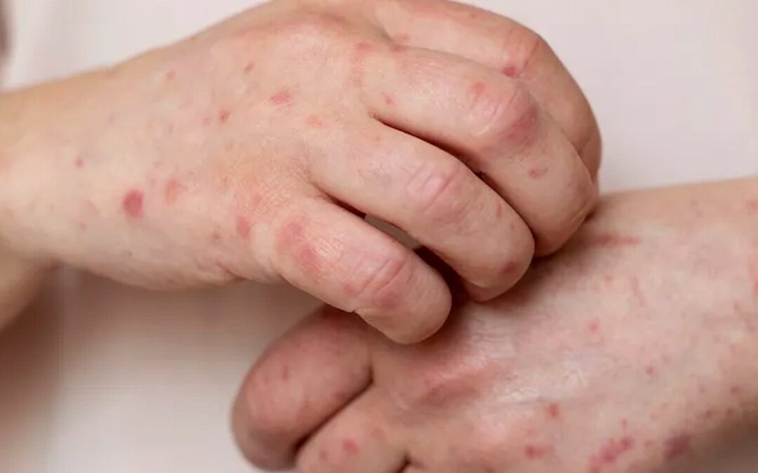 Alertan sobre brotes de sarampión en Torreón: 4 casos confirmados