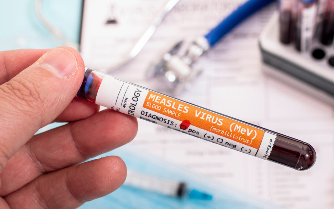 Confirman Segundo Caso de Sarampión en Broomfield: Riesgos y Precauciones