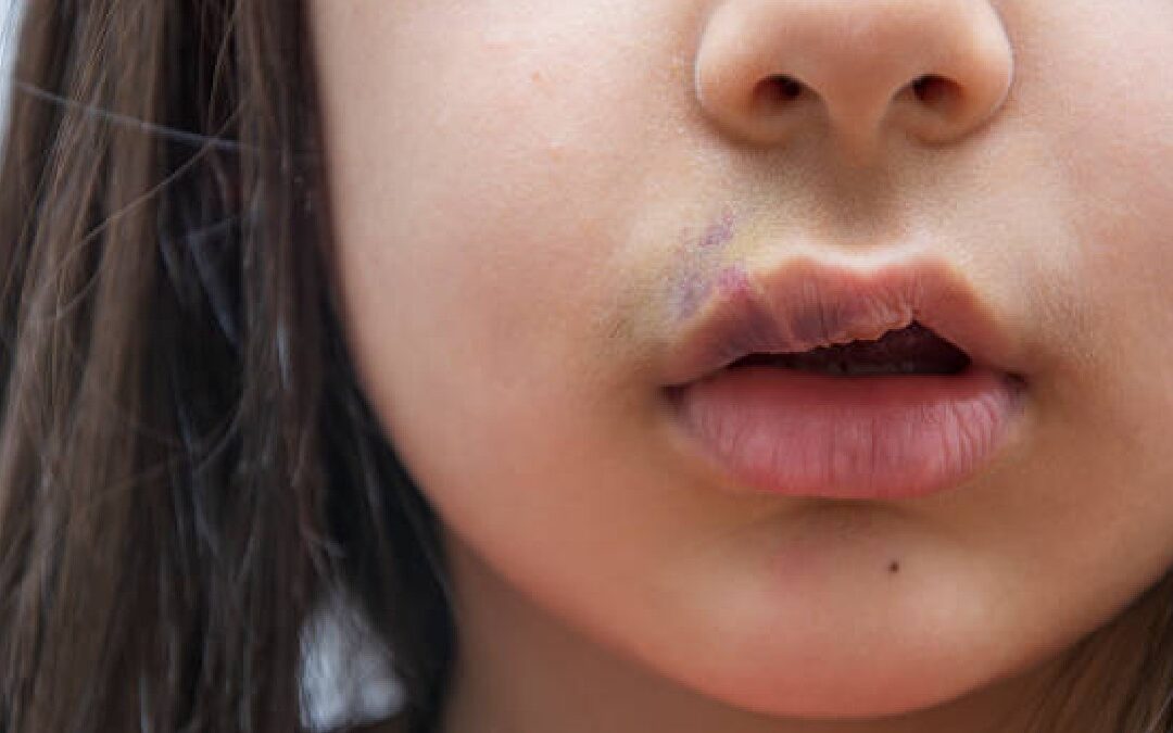 Hendiduras Orofaciales: Una de las Malformaciones Congénitas Más Frecuentes en México