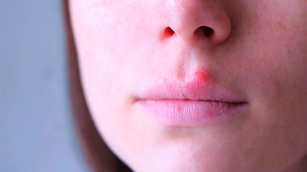 Verruga: Cómo Identificar El Vph Y Métodos Efectivos Para Su Eliminación