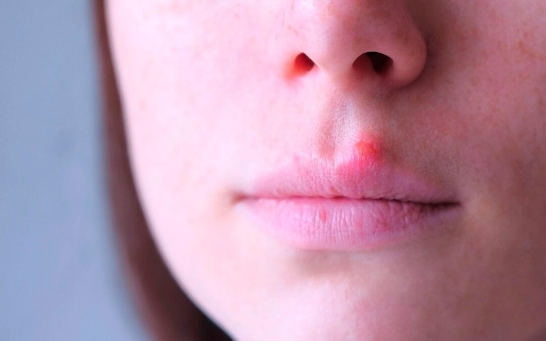 Verruga: Cómo Identificar el VPH y Métodos Efectivos para Su Eliminación