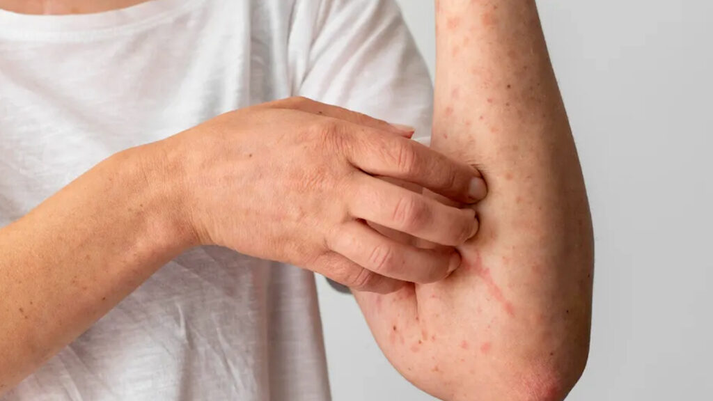 Confirmación De Nuevos Casos De Sarampión En El Paso: Autoridades Llaman A La Vacunación - Noticias Notivalle Confirmación De Nuevos Casos De Sarampión En El Paso: Autoridades Llaman A La Vacunación