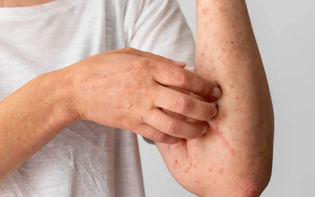 Confirmación de Nuevos Casos de Sarampión en El Paso: Autoridades Llaman a la Vacunación