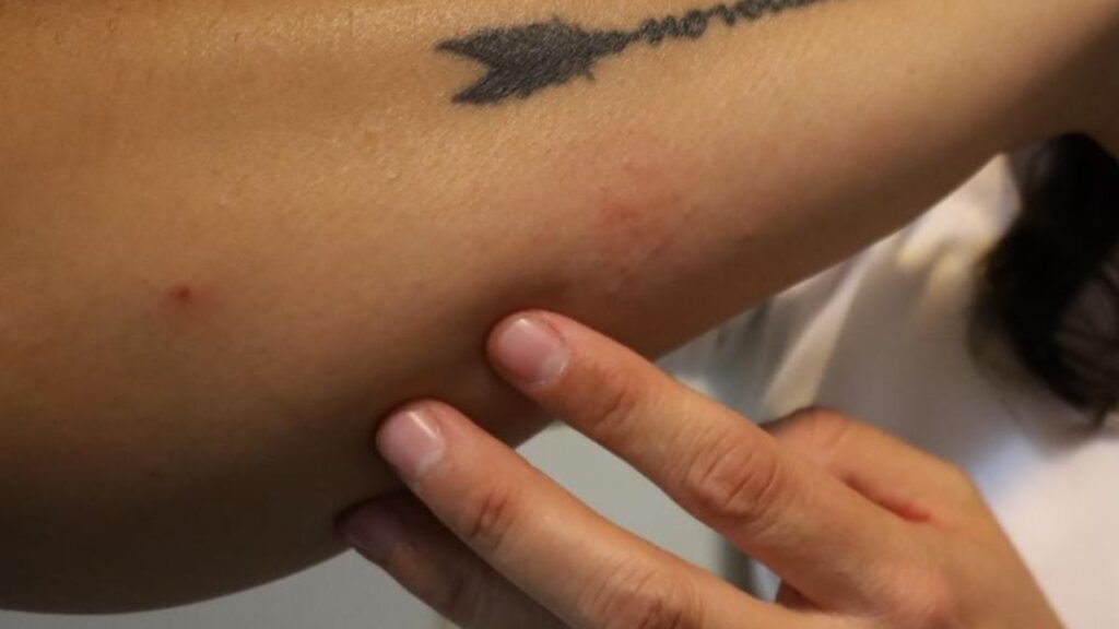 Detección Temprana: 82 Casos Sospechosos De Cáncer De Piel En Torreón Durante Brigada De Salud