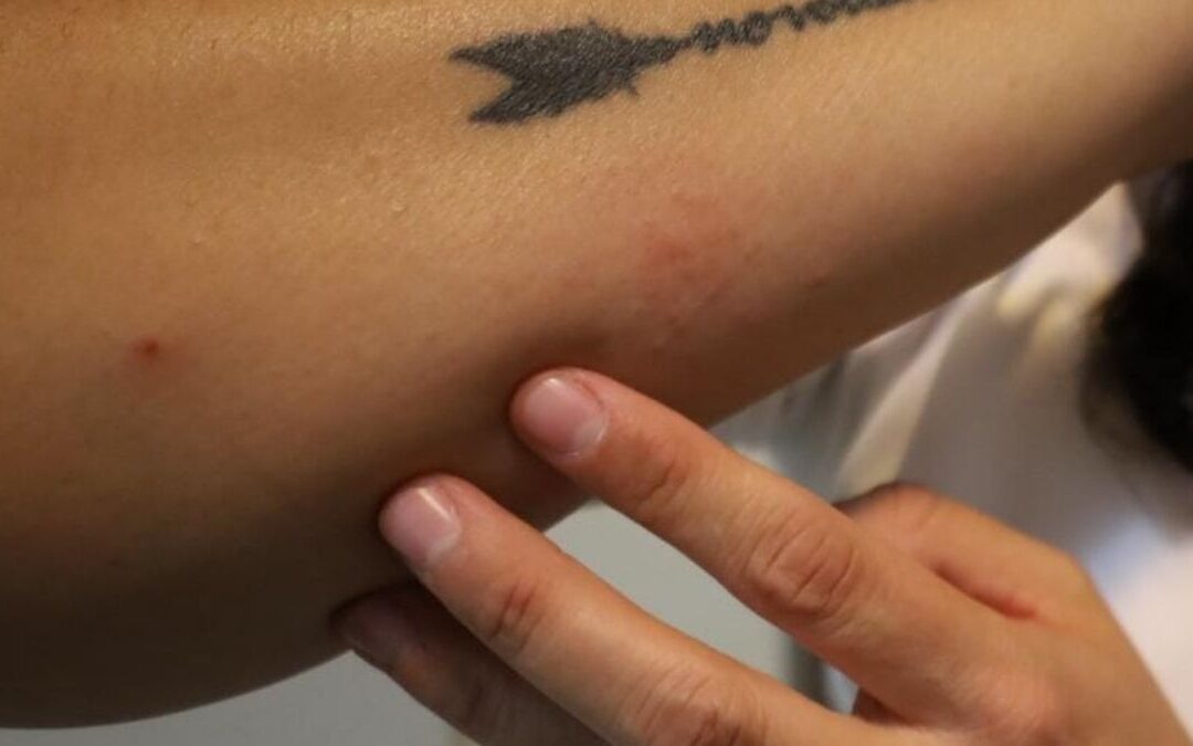 Detección Temprana: 82 Casos Sospechosos de Cáncer de Piel en Torreón Durante Brigada de Salud