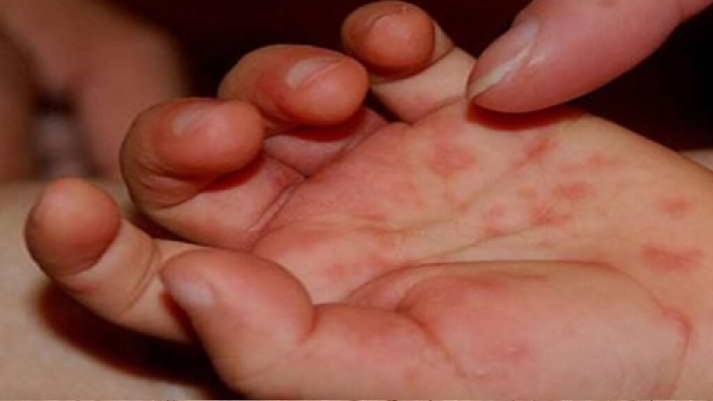 Investigación En Torreón: ¿Fue La Rickettsia La Causa Del Fallecimiento De Una Niña De 9 Años?