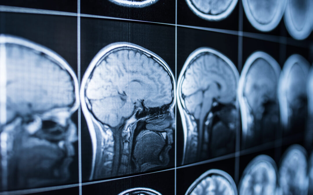 Lesiones Cerebrales en Colorado: Medio Millón de Residentes Afectados y Nueva Herramienta de Evaluación
